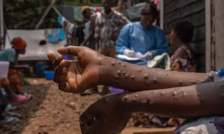 Mais de 1,5 mil casos de Mpox foram registrados no Brasil em 2024